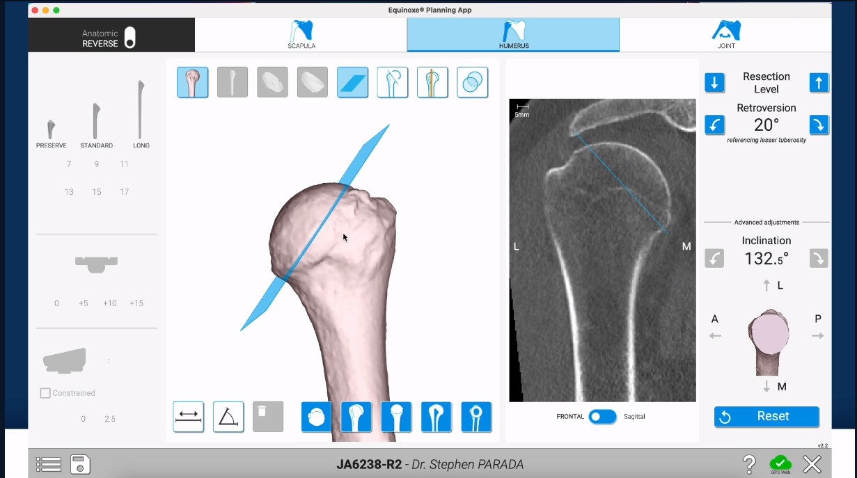 Winglet Originals #021: Reverse Shoulder Arthroplasty – thumbnail 7 of 11