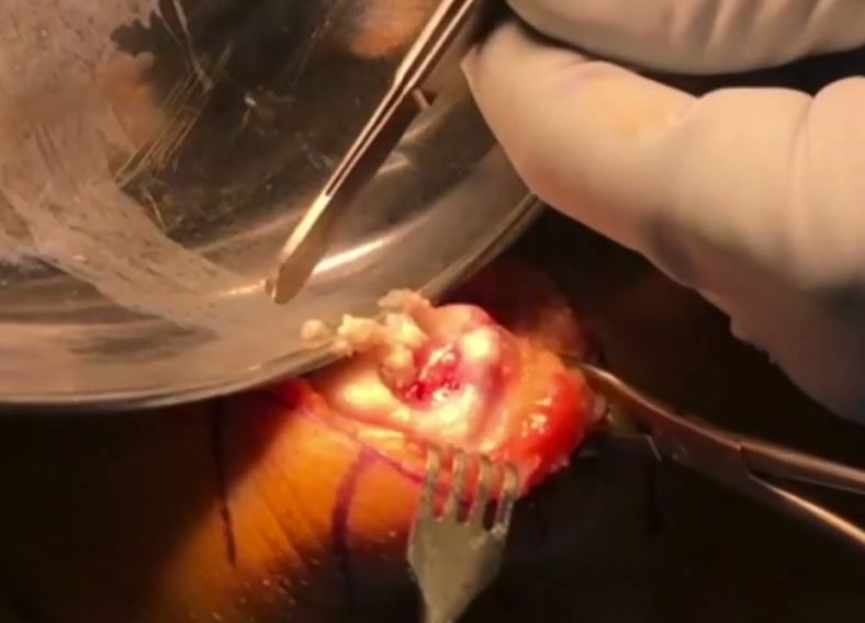 #181: Insights from the OR - Knorpelchirurgie III – thumbnail 7 of 11