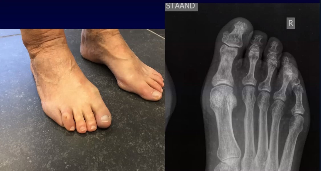 Winglet Originals #013: Minimally Invasive Foot Surgery – thumbnail 7 of 13