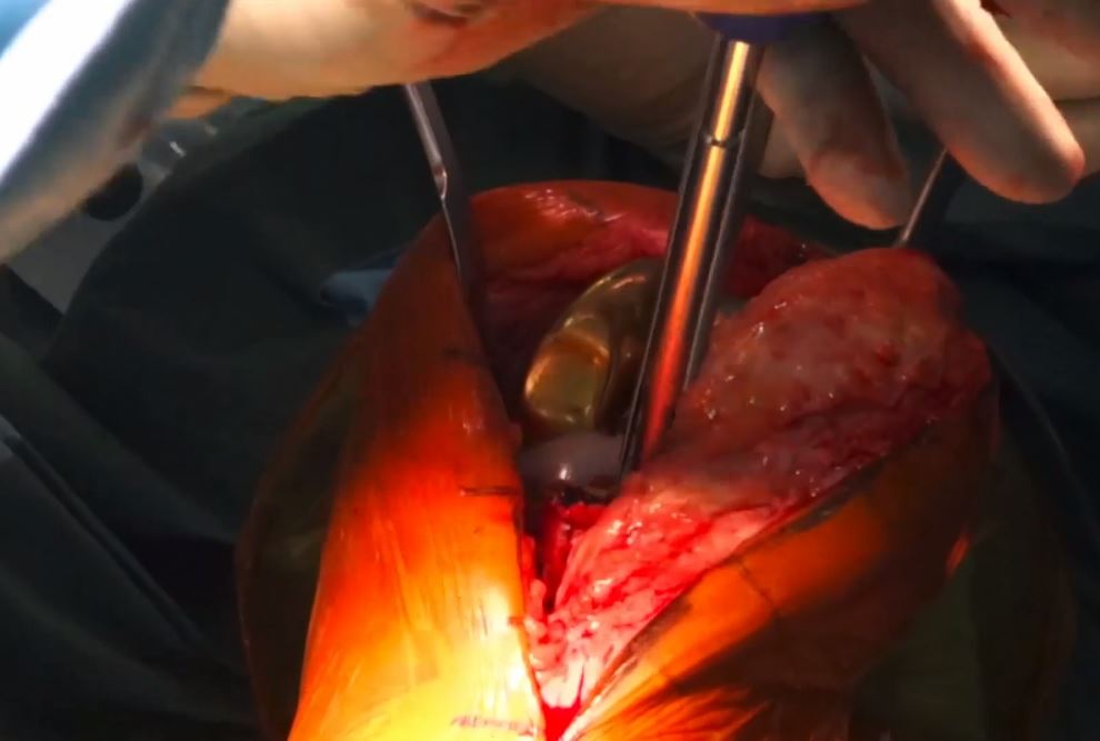 #177: Insights from the OR - Infektionen in der Endoprothetik – thumbnail 7 of 11