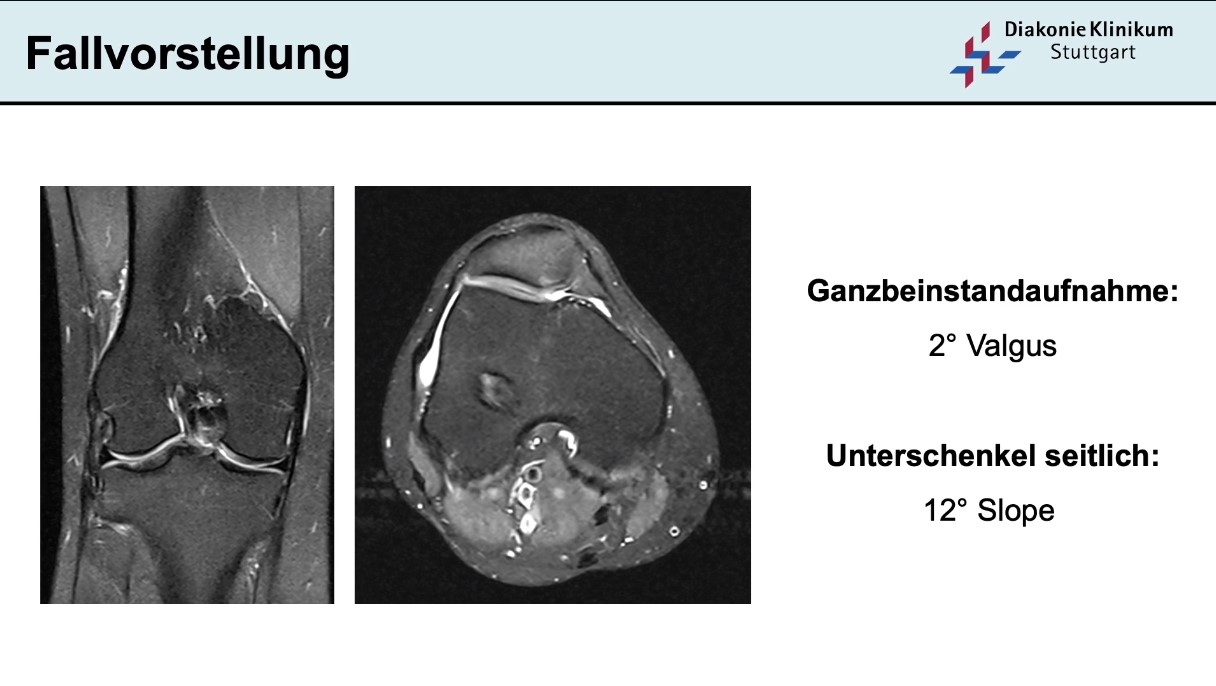 AGAnywhere Road2Berlin – Episode 2: Ossäre Deformitäten bei Kreuzbandverletzung – thumbnail 7 of 11