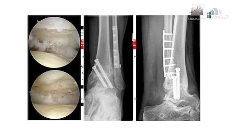 #223: Sprunggelenksarthrose - Therapiemöglichkeiten und Grenzbereiche – thumbnail 7 of 10