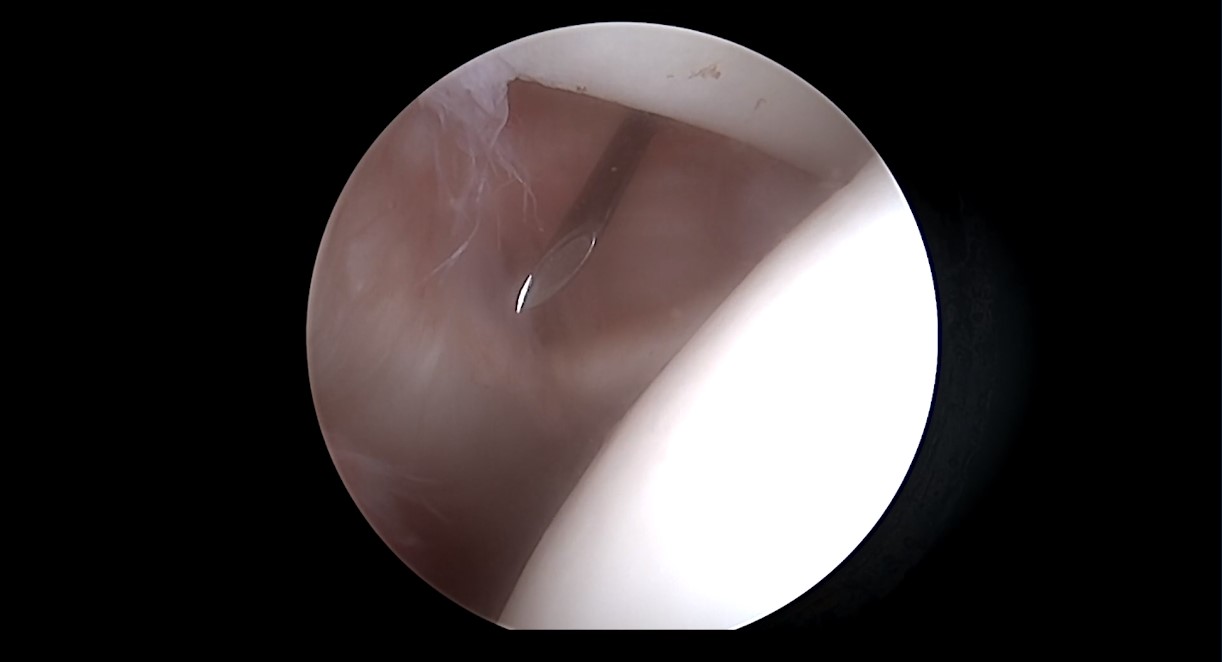 Across the Atlantic: American and European Insights on All Things Biceps Tendon – thumbnail 7 of 16