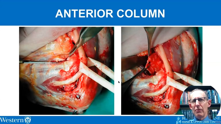 #1212: Insights from the OR - Capsular Release of the Elbow – thumbnail 7 of 8