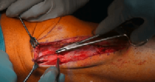 #1010: Insights from the OR - Patellainstabilität – thumbnail 7 of 9