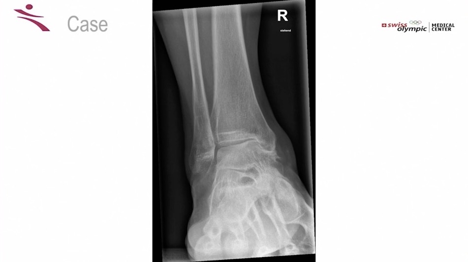 AGAnywhere Monthly - #007: Arthrose am Sprunggelenk – thumbnail 8 of 13