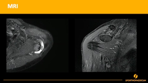 Winglet Originals #003: Acute and Chronic Pathologies of the AC Joint – thumbnail 8 of 11