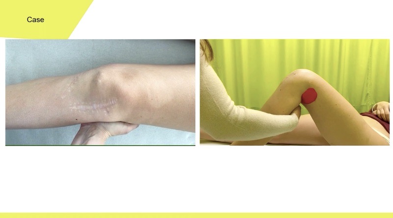 Winglet Originals #001: Acute and Chronic Medial Instabilities of the Knee – thumbnail 8 of 11