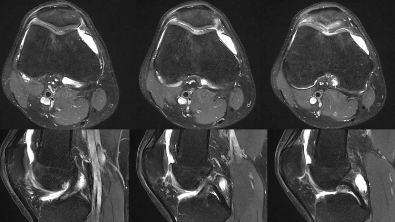 FKT@Home 2022 (Day 2) - Treatment of Cartilage Defects in the Knee – thumbnail 8 of 11