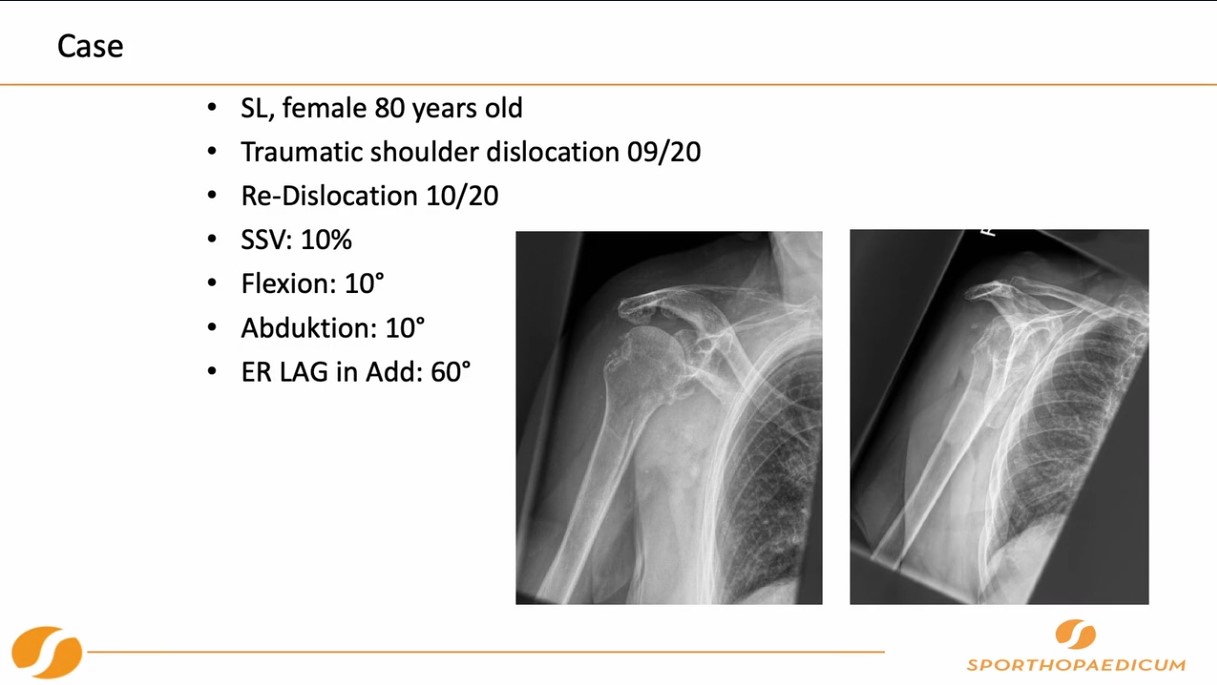 Winglet Originals #023: Planning & Augmented Reality in Shoulder Surgery – thumbnail 8 of 11