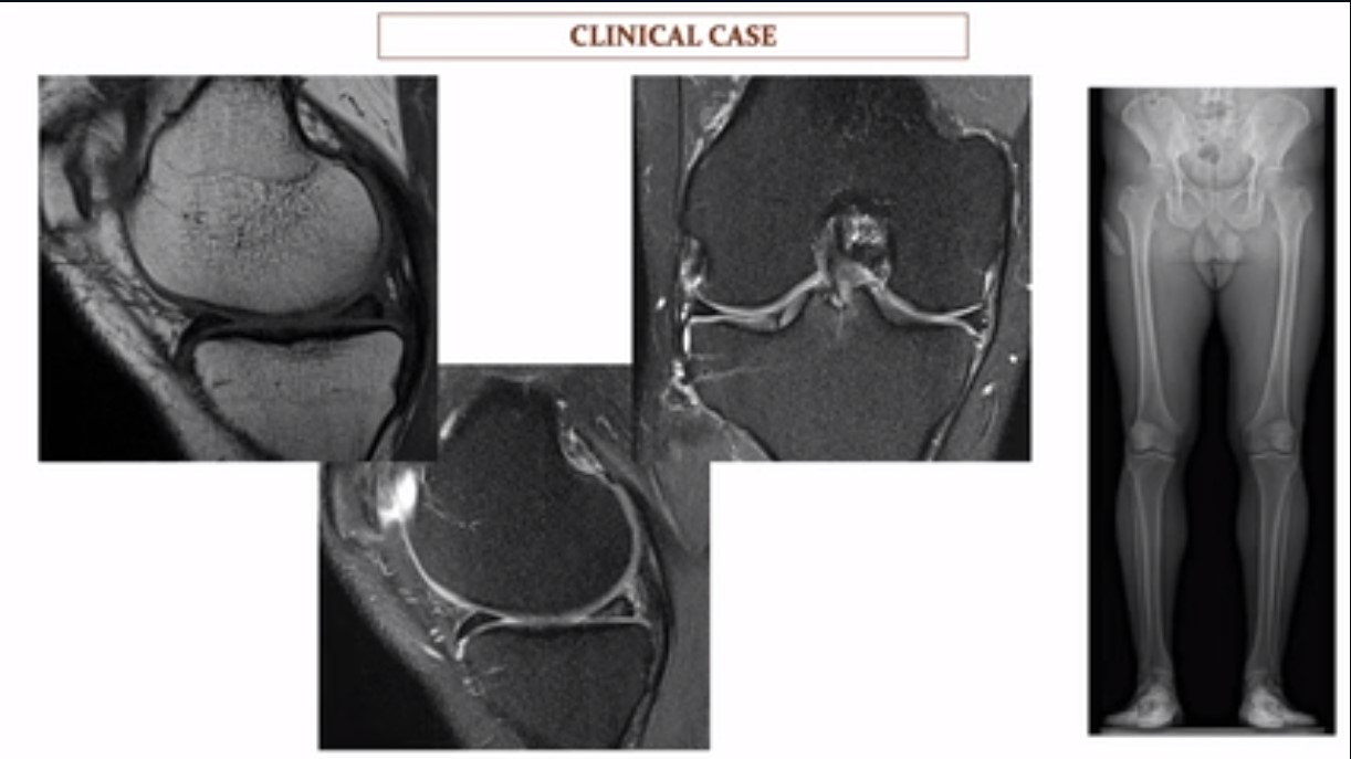 ICRS TV Series - #004: Case Based Learning – Orthobiologics & Aging Athletes – thumbnail 8 of 12