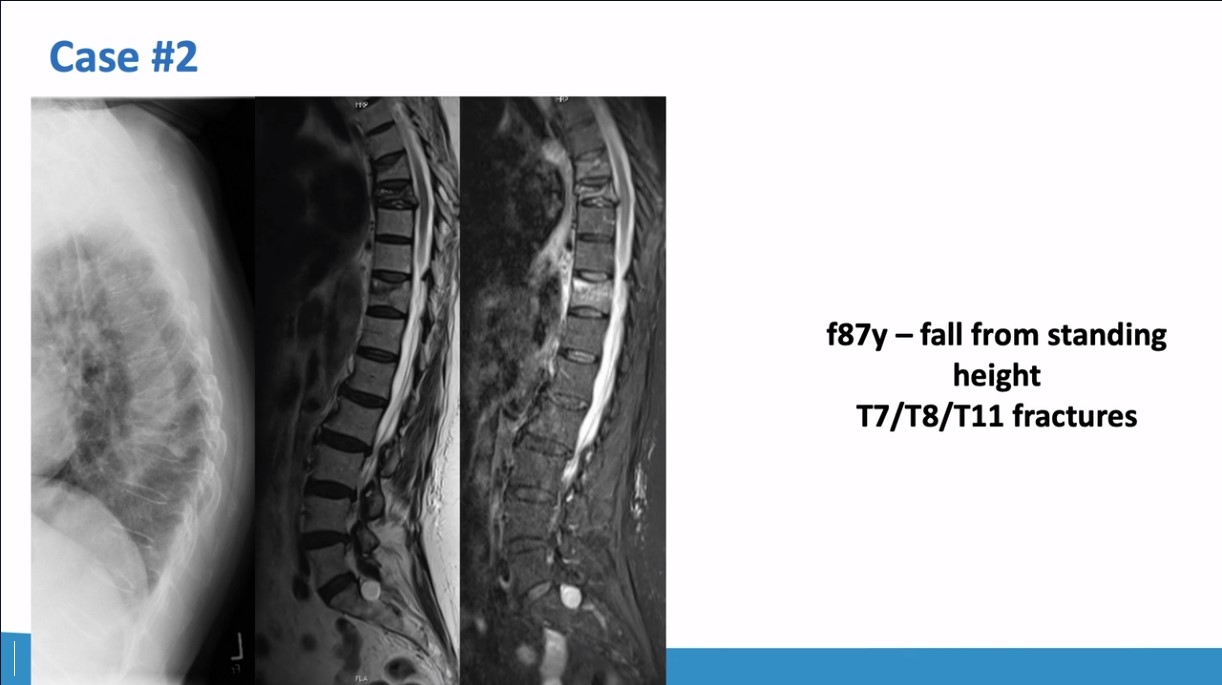 Winglet Originals #020: Minimally-Invasive Fixation of Thoracolumbar Osteoporotic Vertebral Compression Fractures – thumbnail 8 of 13