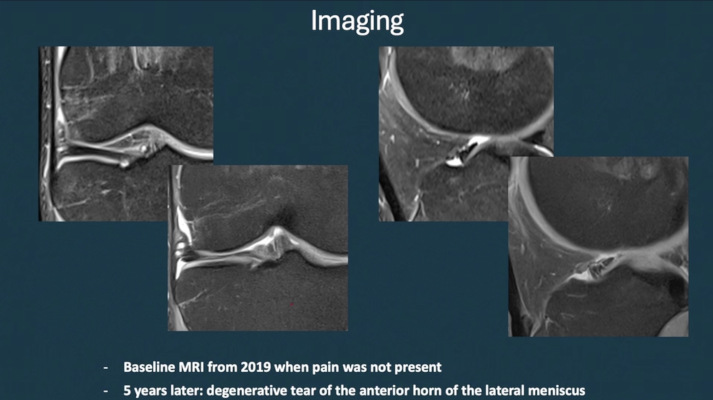 ICRS TV Series - #010: Meniscus Lesions: To Operate or Not To Operate? – thumbnail 8 of 10