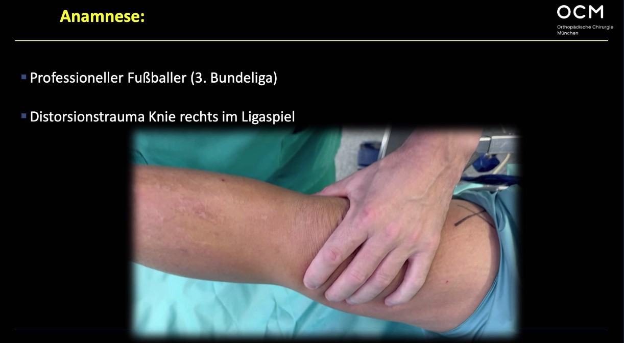 AGAnywhere Road2Berlin – Episode 2: Ossäre Deformitäten bei Kreuzbandverletzung – thumbnail 8 of 11