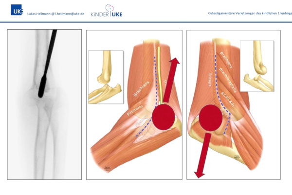 AGAnywhere Monthly - #034: Osteoligamentäre Verletzungen des kindlichen Knies und Ellenbogens – thumbnail 8 of 10