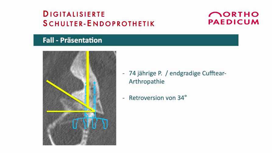 #175: Mein Plan, meine Umsetzung - Digitalisierte Schulterendoprothetik – thumbnail 8 of 17