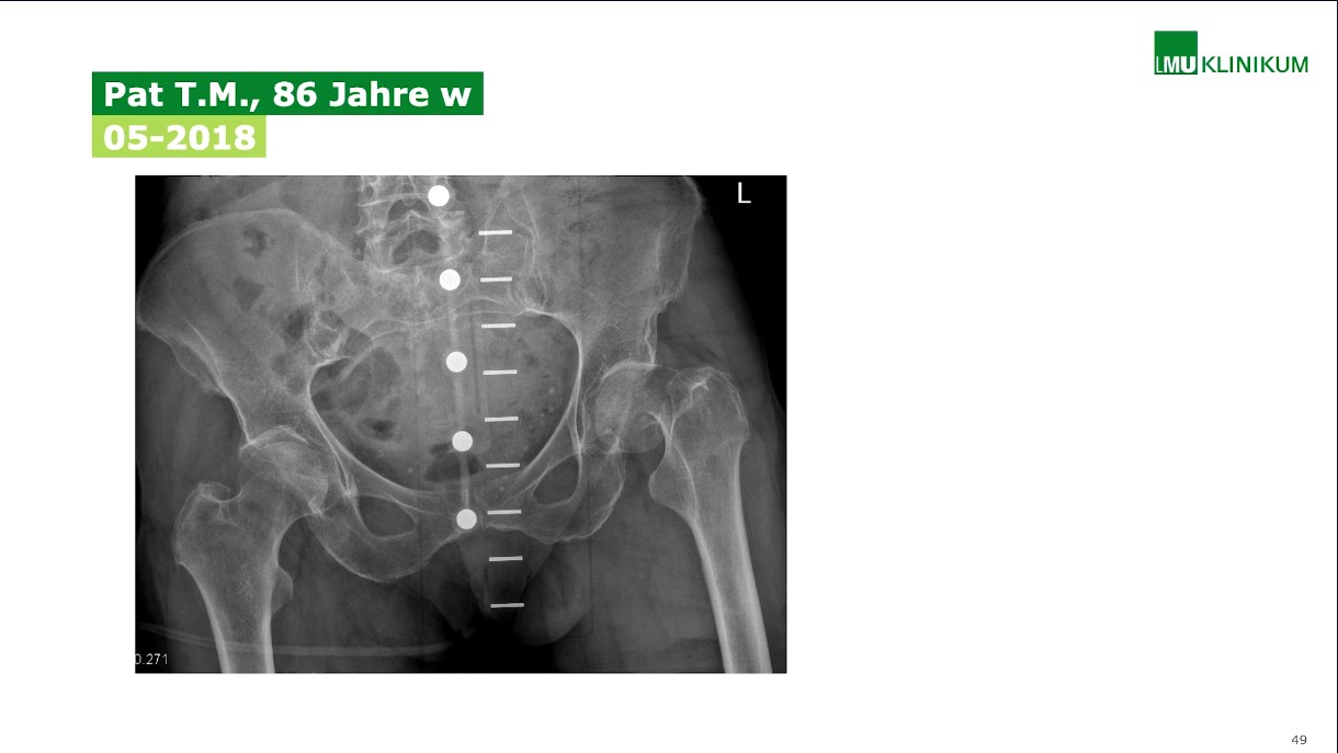 #904: Die osteoporotische Wirbelkörperfraktur: Therapie und Prävention – thumbnail 8 of 10