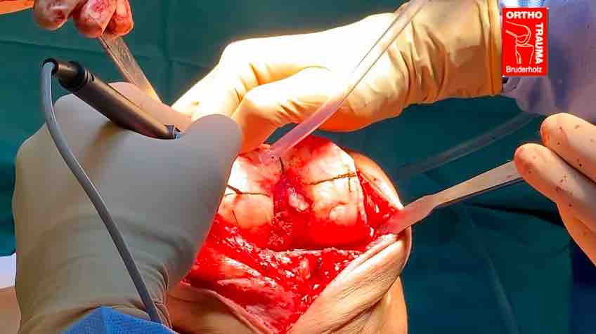 Orthopedic Film Festival 2022 - Reconstruction – thumbnail 8 of 11