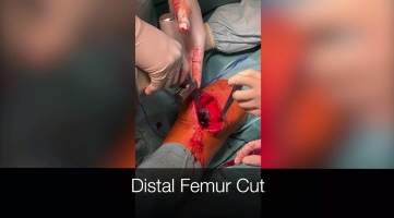 Orthopedic Film Festival 2023 – Recon, Trauma & Spine – thumbnail 8 of 17