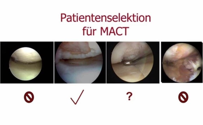 #181: Insights from the OR - Knorpelchirurgie III – thumbnail 8 of 11