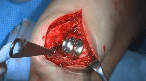 #1010: Insights from the OR - Patellainstabilität – thumbnail 8 of 9