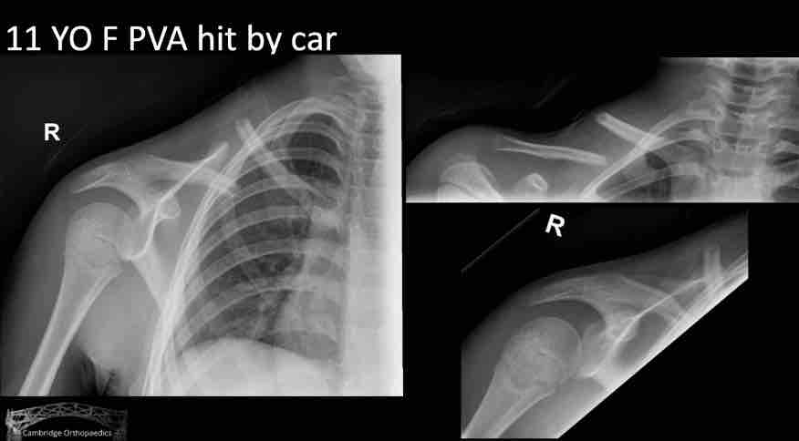 Winglet Originals #005: Clavicle Fractures – thumbnail 8 of 11