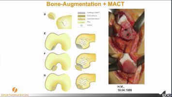Winglet Originals #011: What Matters in Surgical Cartilage Repair – thumbnail 8 of 12