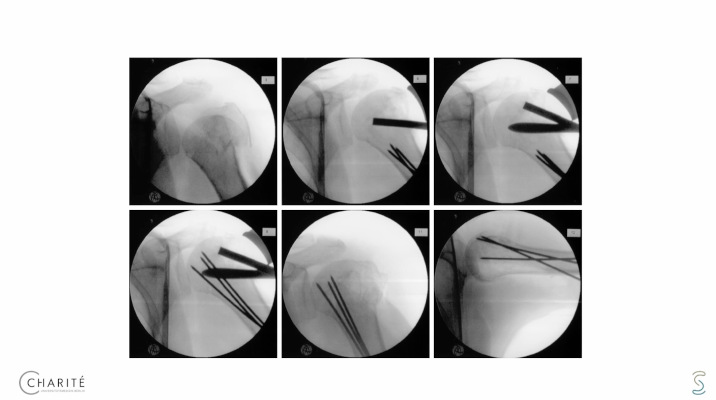 Winglet Originals #028: Complex Humerus Fractures – thumbnail 8 of 11