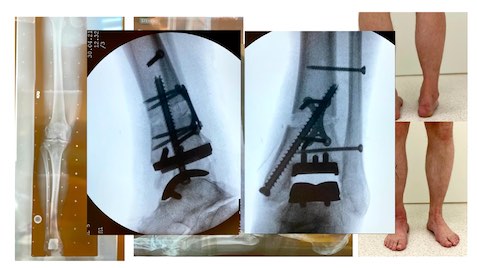 #223: Sprunggelenksarthrose - Therapiemöglichkeiten und Grenzbereiche – thumbnail 8 of 10