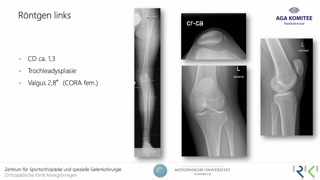 AGAnywhere Monthly - #022: Die patellofemorale Instabilität – thumbnail 8 of 12