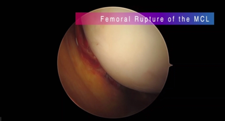 Winglet Originals #014: Basics in Knee Arthroscopy – thumbnail 8 of 19