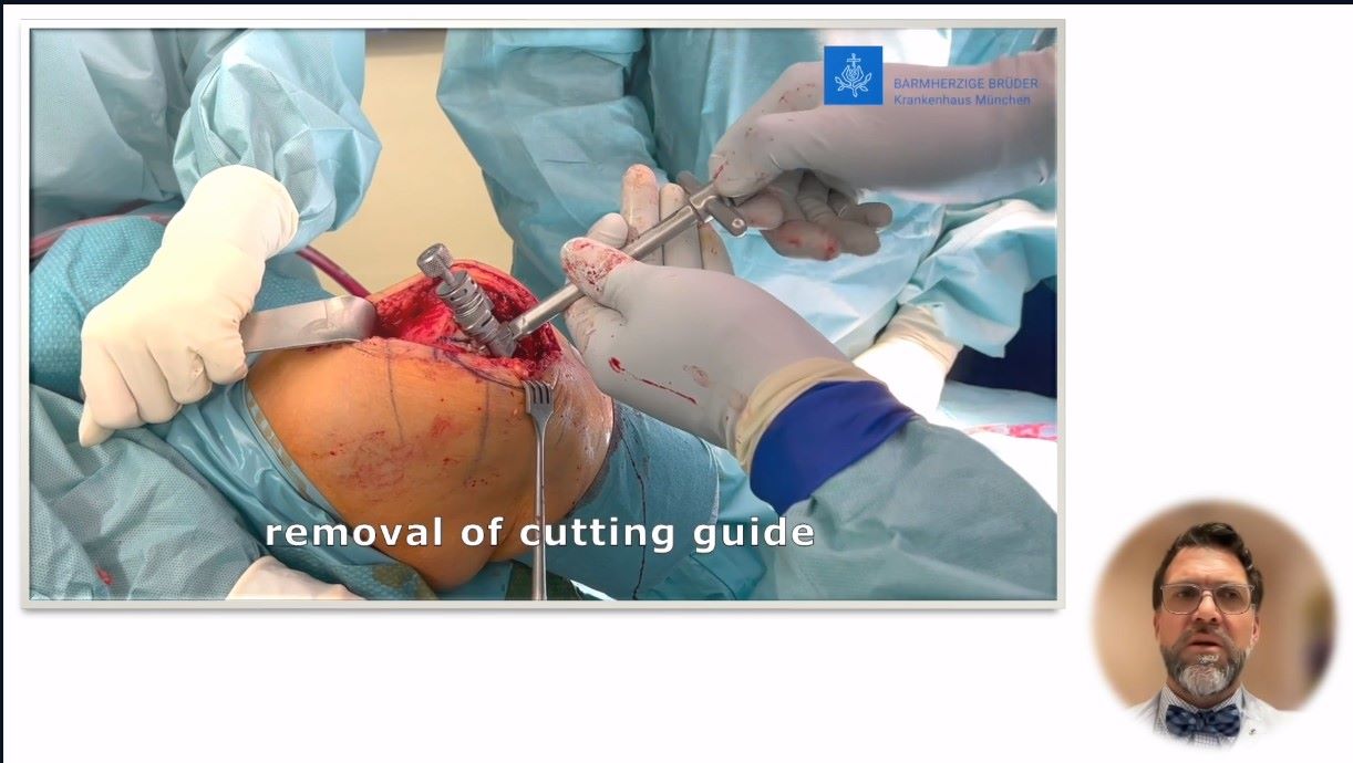 Winglet Originals #019: Partial Knee Arthroplasty – thumbnail 8 of 11