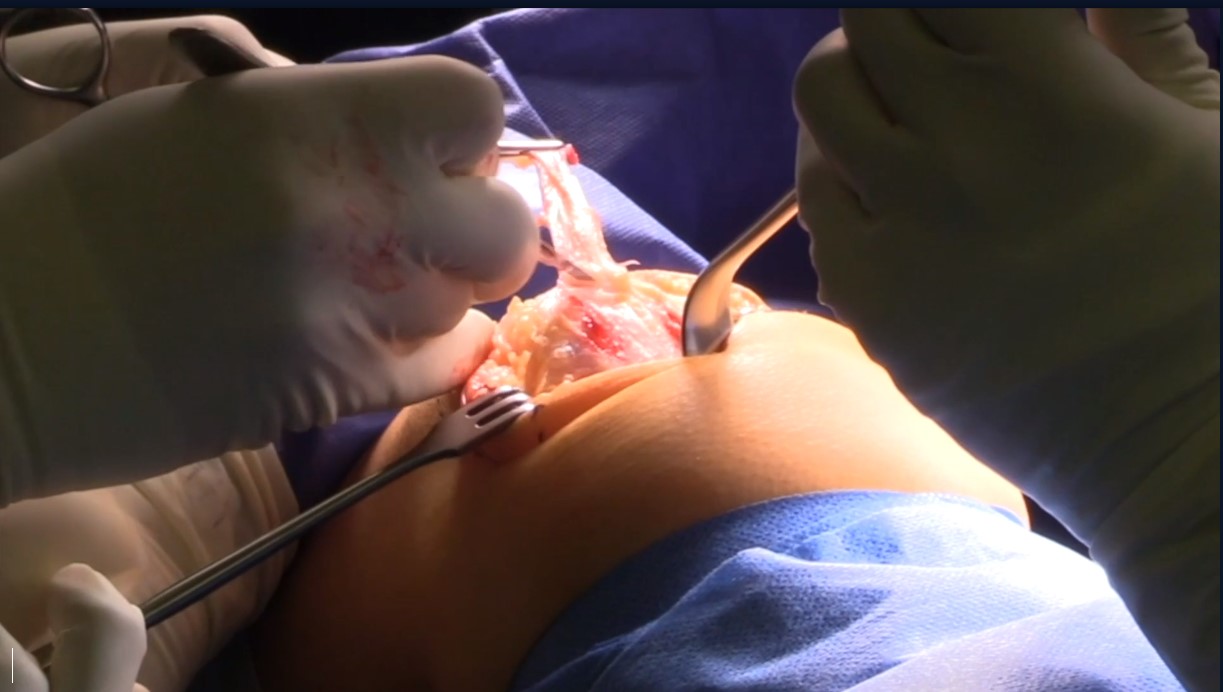 Across the Atlantic: American and European Insights on Patellar Instability – thumbnail 8 of 14