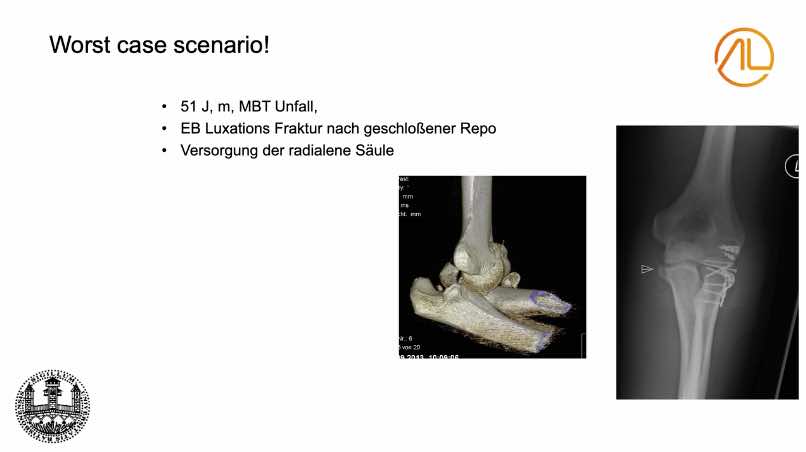AGAnywhere Monthly - #016: Frakturen des Ellenbogens - Spannungsfeld zwischen Rekonstruktion und Ersatz – thumbnail 10 of 12