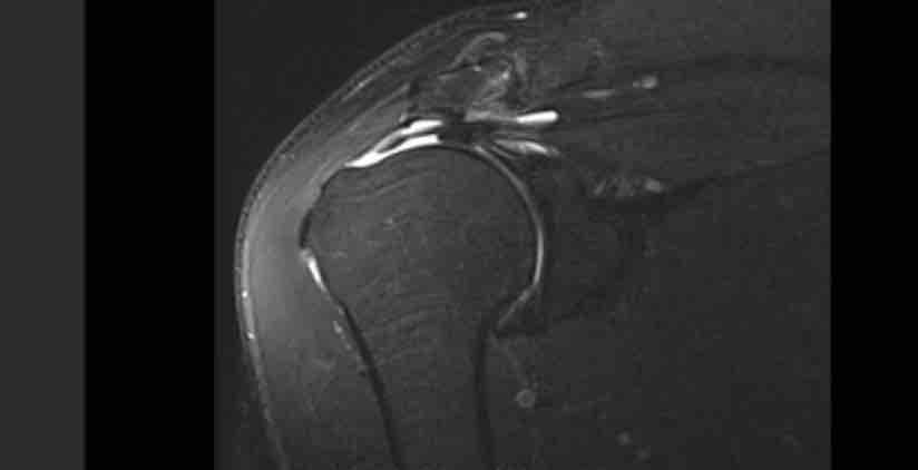 Winglet Originals #009: Massive Tears of the Rotator Cuff – thumbnail 9 of 12