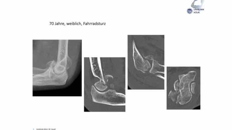 AGAnywhere Monthly - #016: Frakturen des Ellenbogens - Spannungsfeld zwischen Rekonstruktion und Ersatz – thumbnail 9 of 12