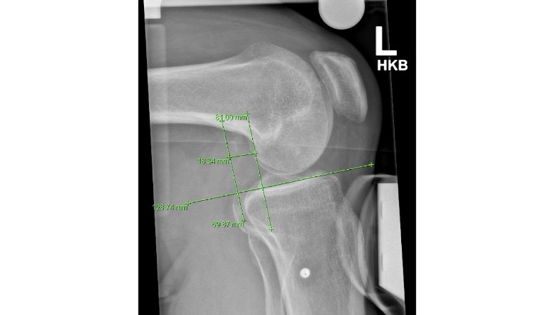 Winglet Originals #001: Acute and Chronic Medial Instabilities of the Knee – thumbnail 9 of 11