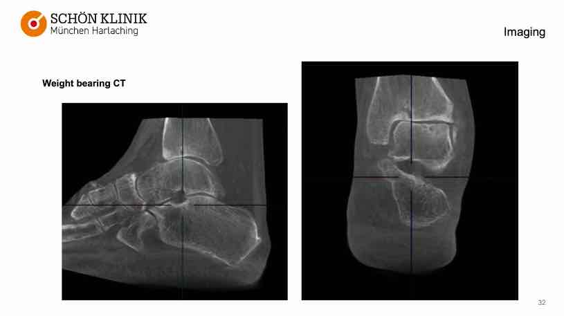 Winglet Originals #004: Malalignment and Early Osteoarthritis of the Ankle – thumbnail 9 of 11