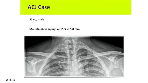 Winglet Originals #003: Acute and Chronic Pathologies of the AC Joint – thumbnail 9 of 11