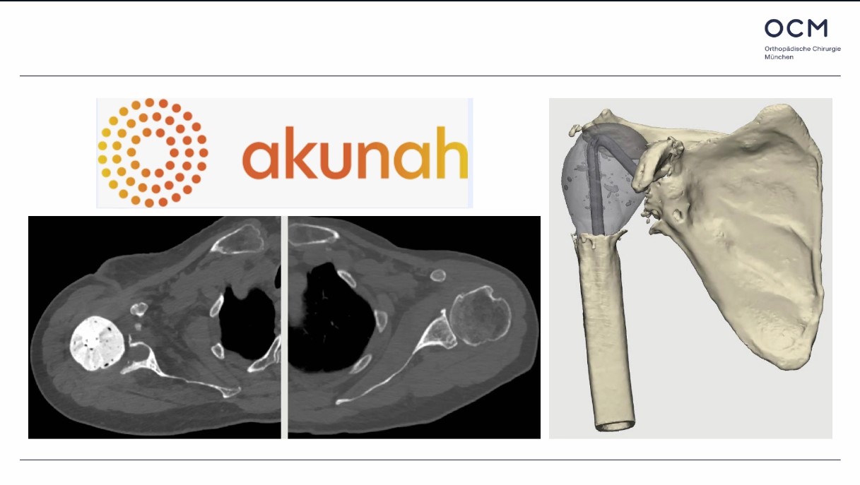 Winglet Originals #023: Planning & Augmented Reality in Shoulder Surgery – thumbnail 9 of 11