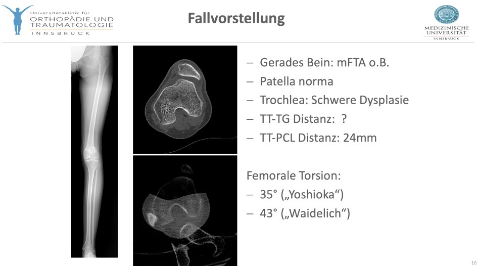 AGAnywhere Monthly - #008: Patellofemorale Instabilität – thumbnail 9 of 12