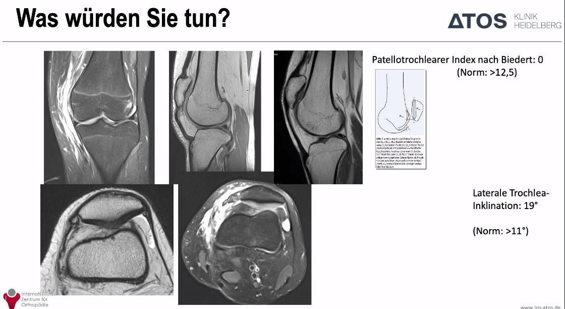 AGAnywhere Monthly - #022: Die patellofemorale Instabilität – thumbnail 9 of 12