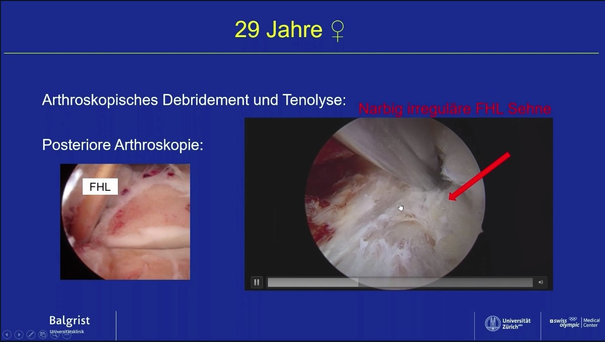 AGAnywhere Monthly - #024: Sehnen rund um das obere Sprunggelenk – thumbnail 9 of 12