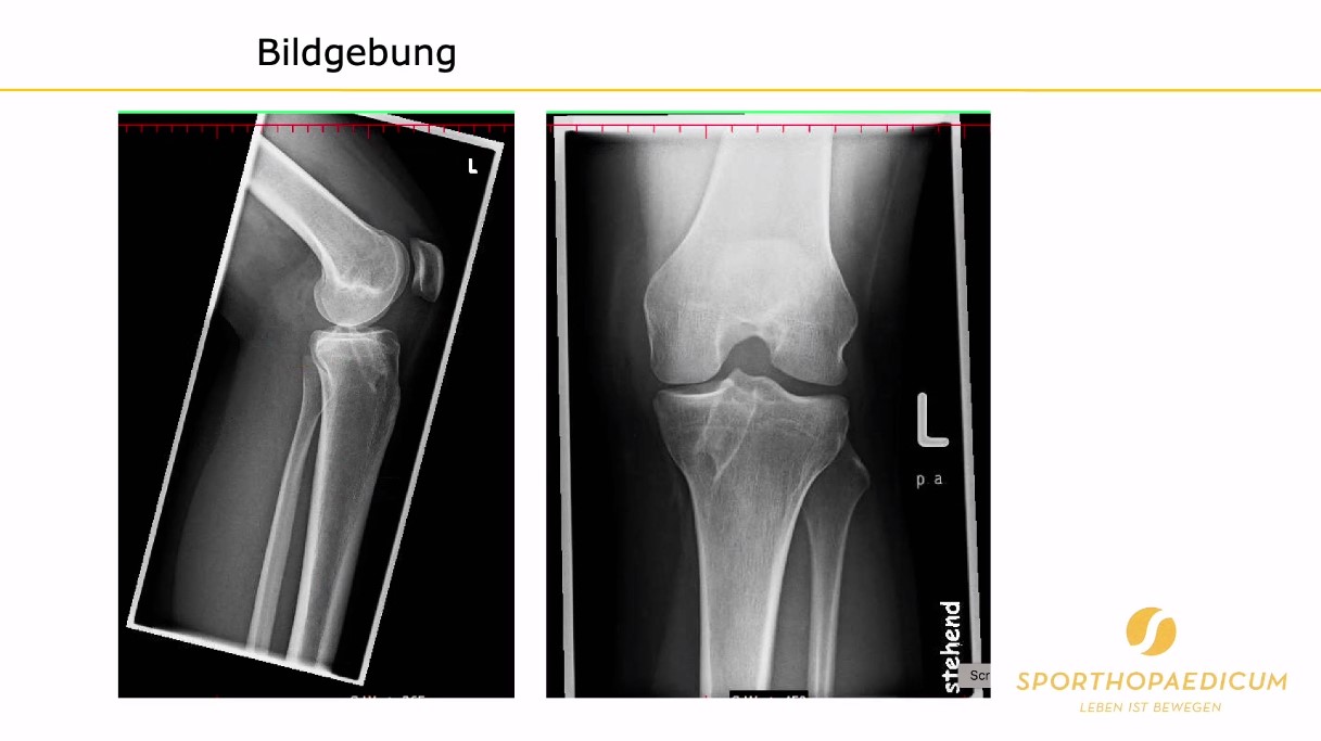 AGAnywhere Road2Berlin – Episode 2: Ossäre Deformitäten bei Kreuzbandverletzung – thumbnail 9 of 11