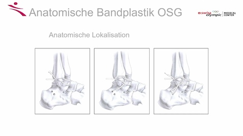 AGAnywhere Monthly - #011: Chronische Sprunggelenkinstabilität – thumbnail 9 of 11