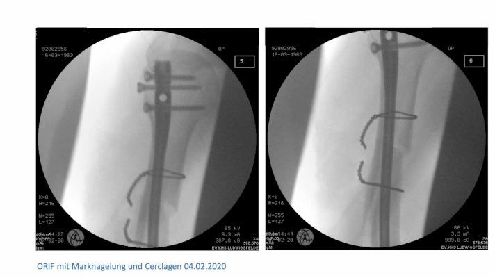 AGAnywhere Monthly - #033: Behandlungsmöglichkeiten der Omarthrose: konservativ - arthroskopisch - Gelenkersatz – thumbnail 10 of 12