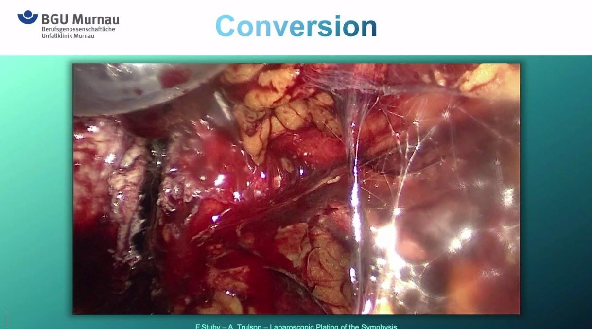 Winglet Originals #018: Minimally Invasive Pelvis & Acetabular Fracture Fixation – thumbnail 9 of 12