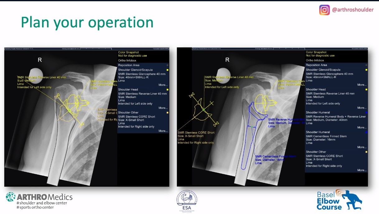 Winglet Originals #021: Reverse Shoulder Arthroplasty – thumbnail 9 of 11