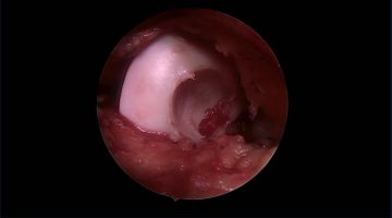 Winglet Originals #011: What Matters in Surgical Cartilage Repair – thumbnail 9 of 12