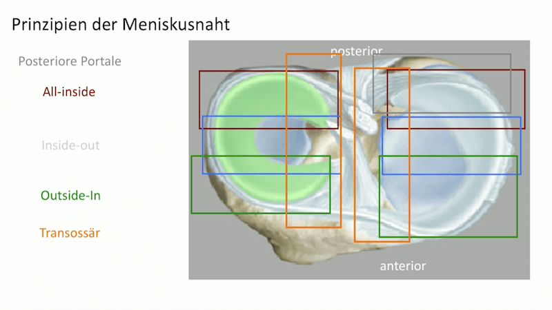 #254: Insights from the OR - Meniskuschirurgie – thumbnail 9 of 12